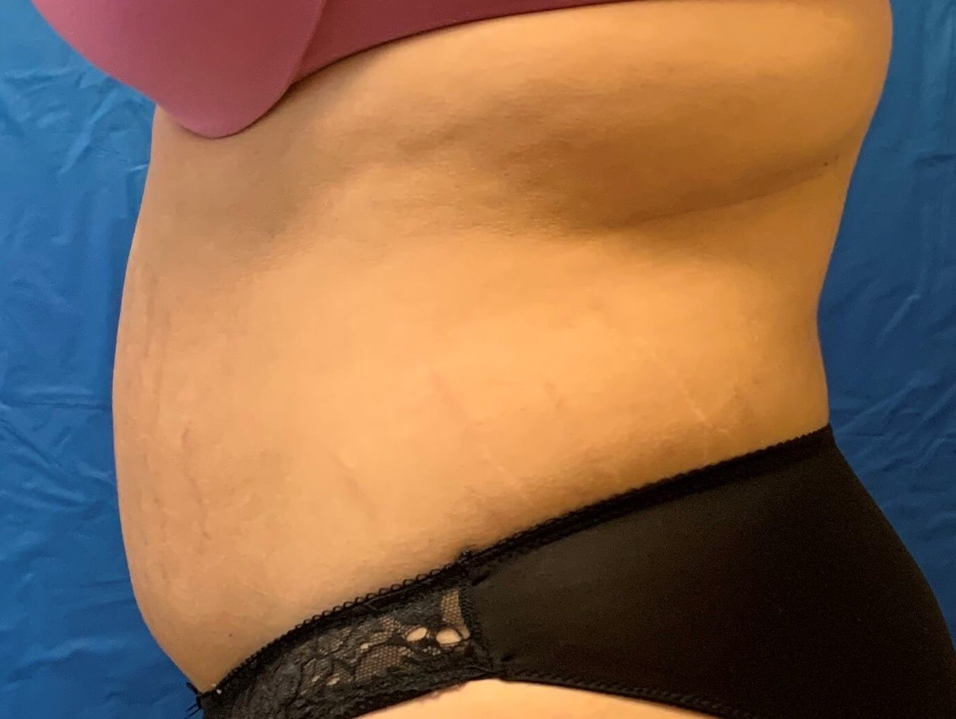 Before and After Pictures After