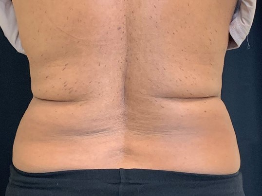 Houston Woman gets TruSculpt to the Back Area for stubborn bra line fat!!