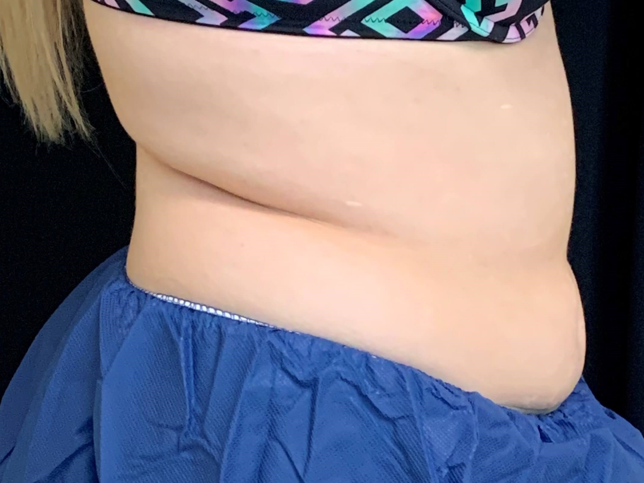 Before and After Pictures Before